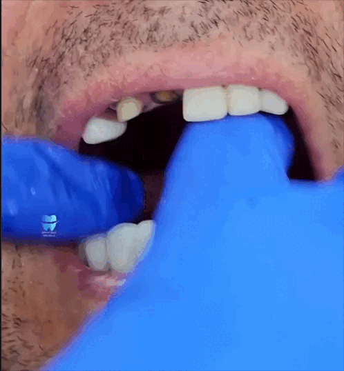 PRÓTESIS DENTALES ADAPTABLES